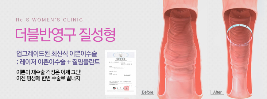 더블반영구 질성형